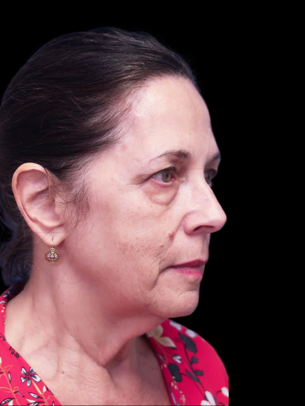 Blepharoplasty Before & After