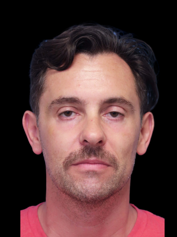 Blepharoplasty Before & After