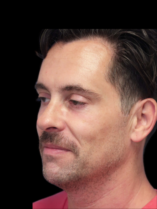 Blepharoplasty Before & After