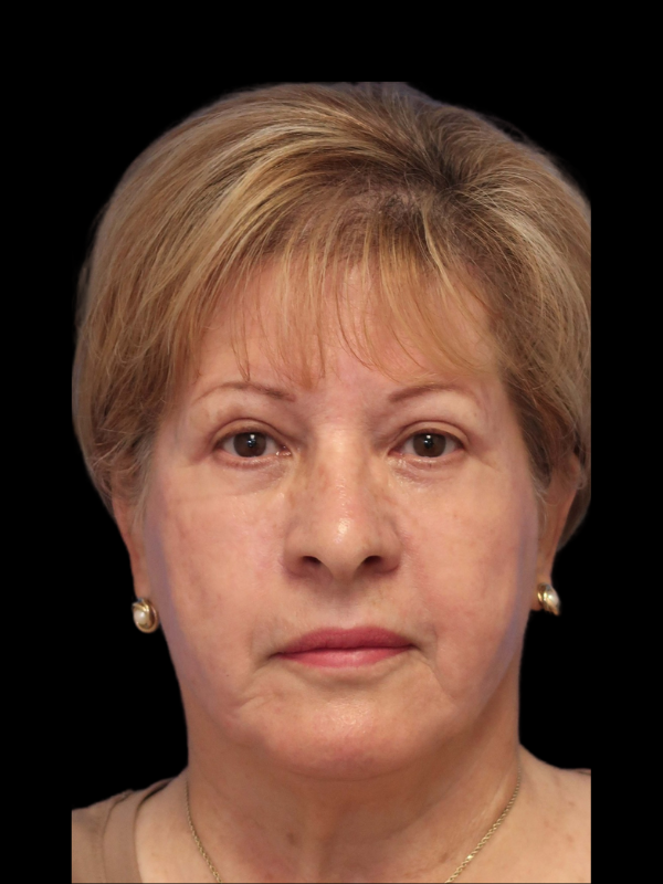Blepharoplasty Before & After
