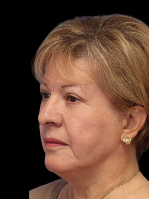 Blepharoplasty Before & After