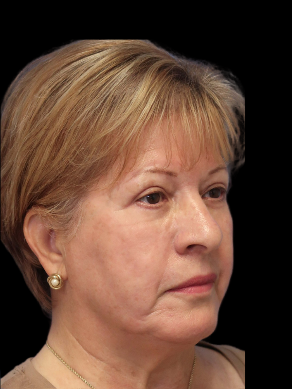 Blepharoplasty Before & After