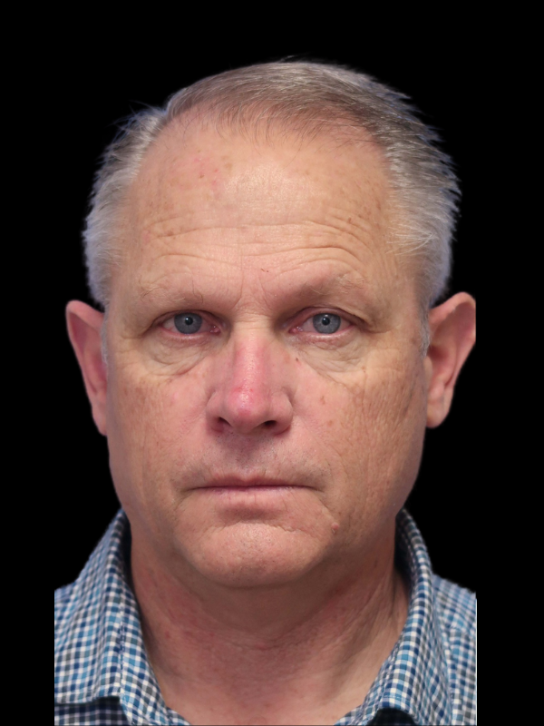 Blepharoplasty Before & After