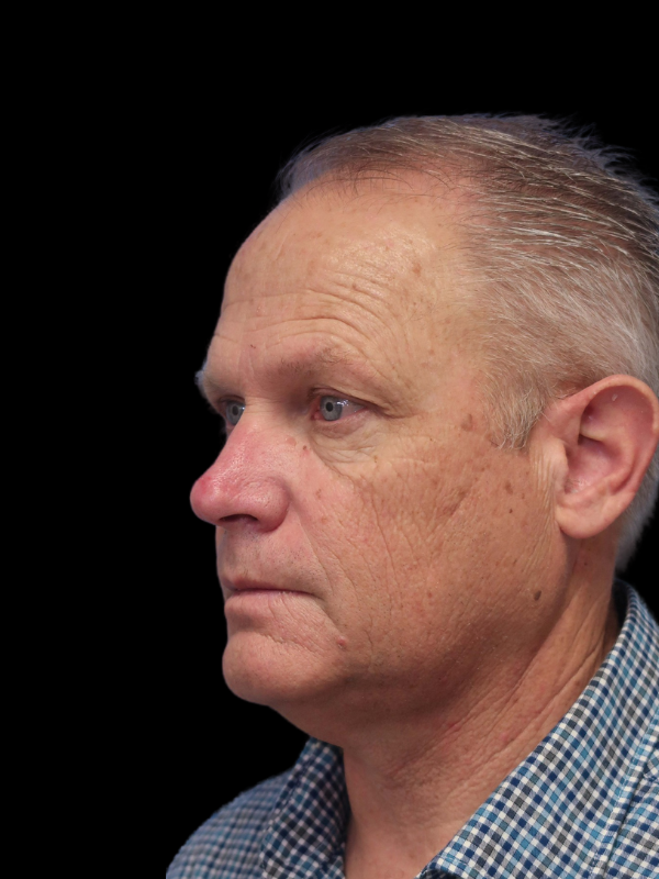 Blepharoplasty Before & After