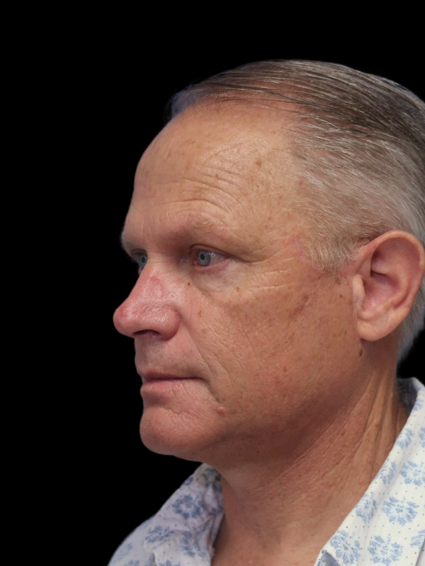 Blepharoplasty Before & After