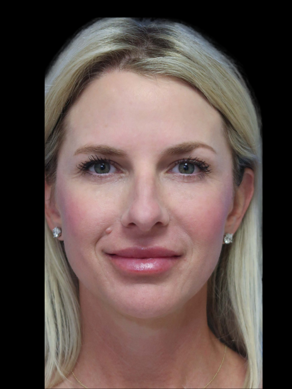 Blepharoplasty Before & After