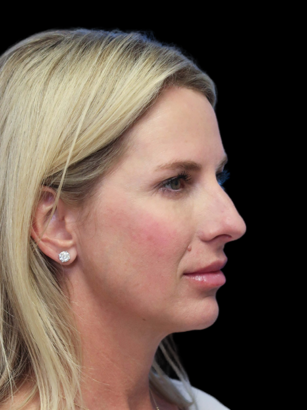 Blepharoplasty Before & After