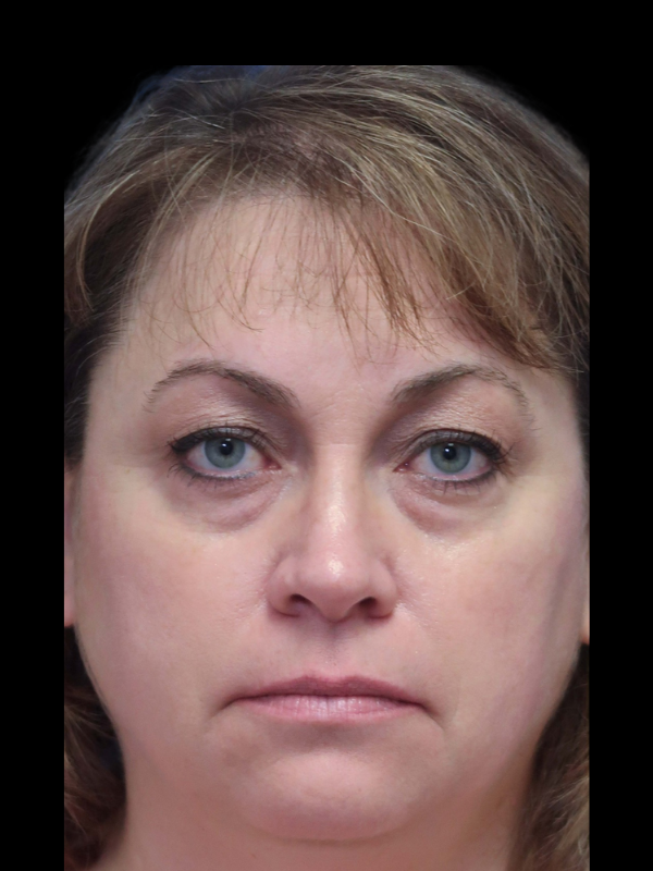 Blepharoplasty Before & After