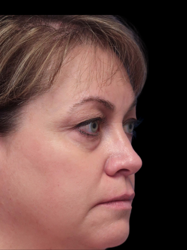 Blepharoplasty Before & After