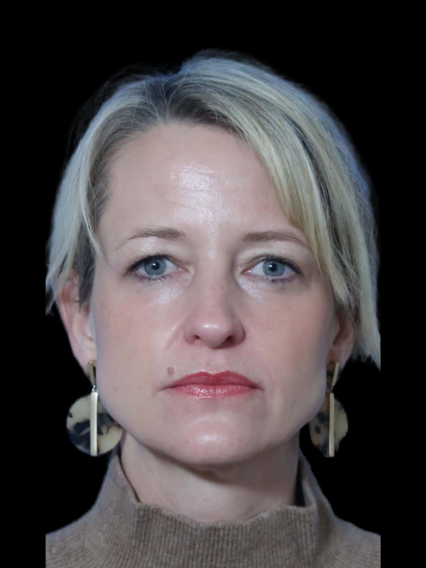 Blepharoplasty Before & After