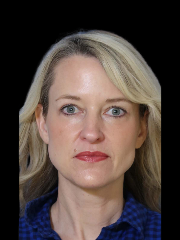 Blepharoplasty Before & After