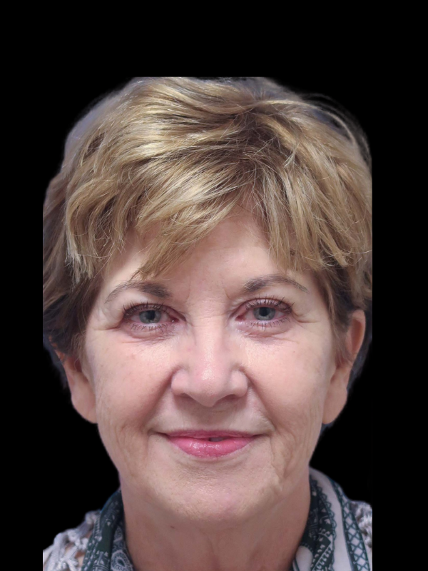 Blepharoplasty Before & After