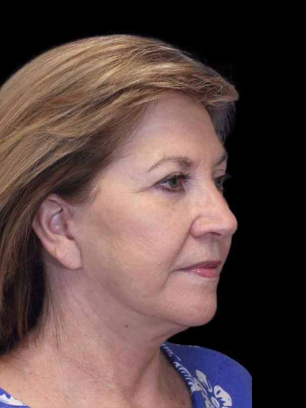 Blepharoplasty Before & After