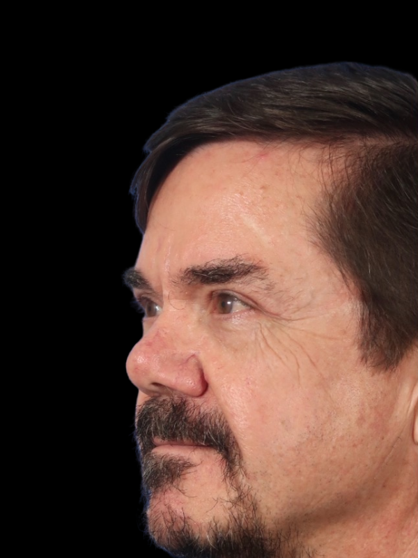 Blepharoplasty Before & After