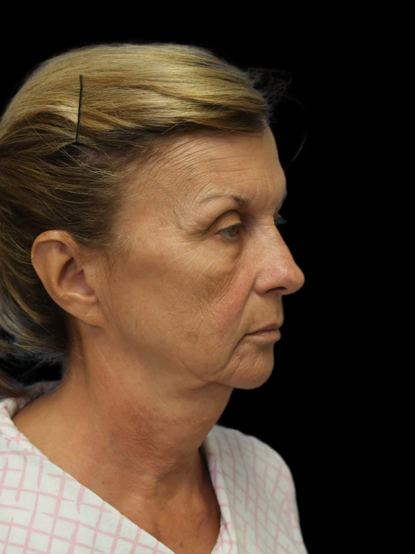 Blepharoplasty Before & After