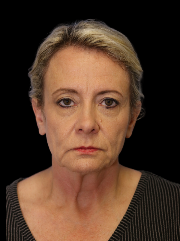 Blepharoplasty Before & After