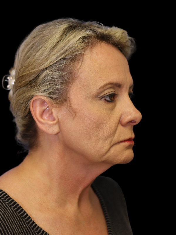 Blepharoplasty Before & After