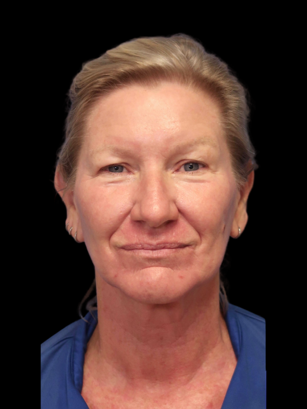 Blepharoplasty Before & After