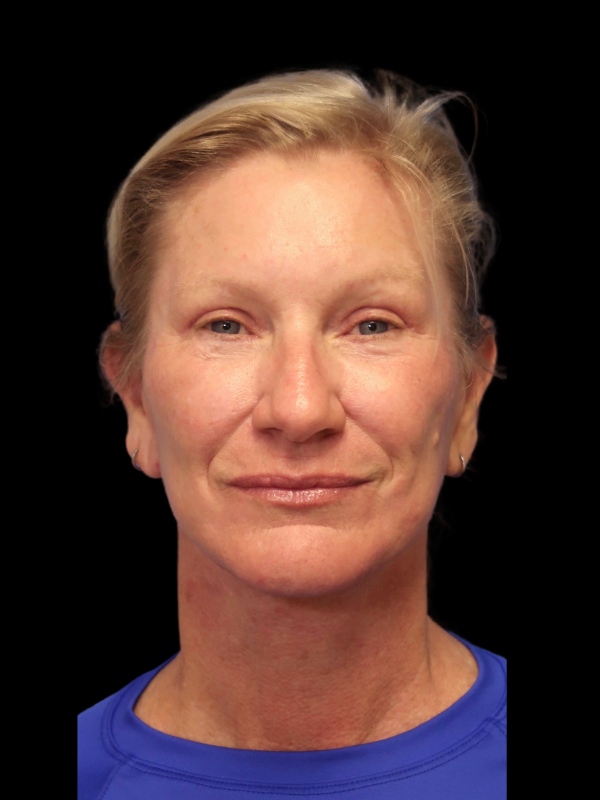 Blepharoplasty Before & After