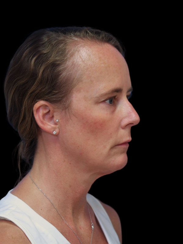 Blepharoplasty Before & After