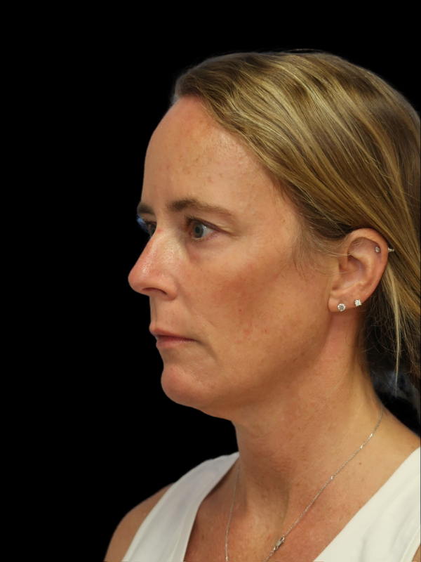 Blepharoplasty Before & After