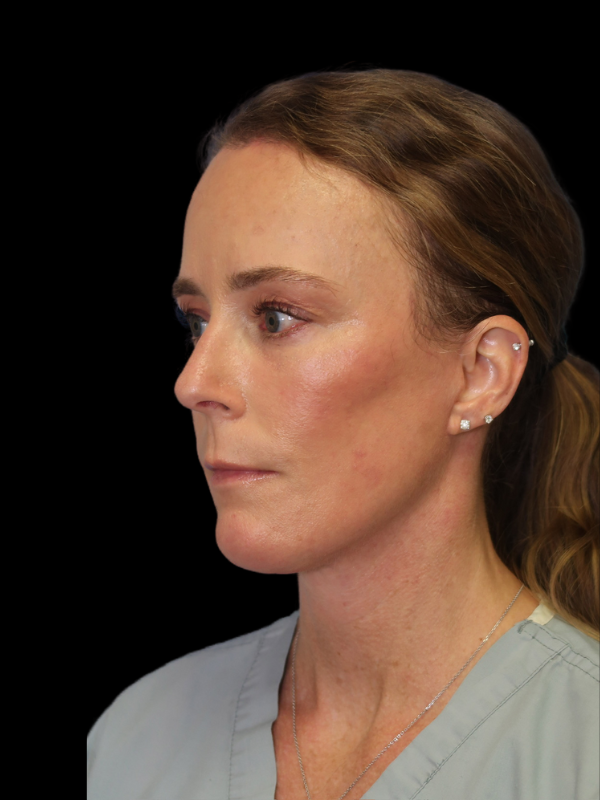 Blepharoplasty Before & After