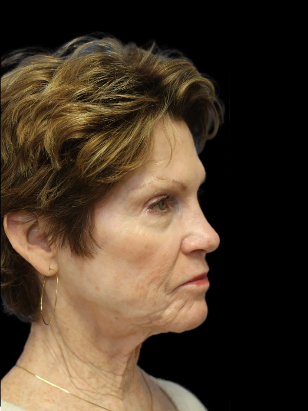 Blepharoplasty Before & After