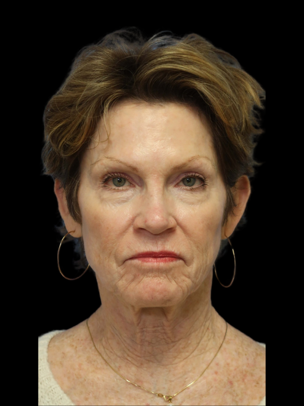 Blepharoplasty Before & After