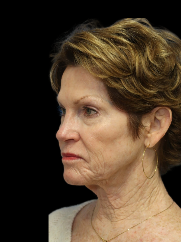 Blepharoplasty Before & After