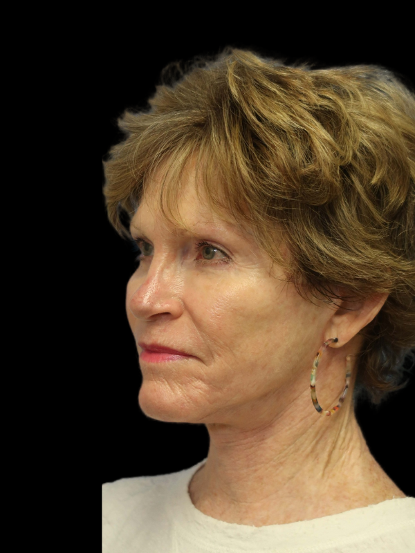 Blepharoplasty Before & After