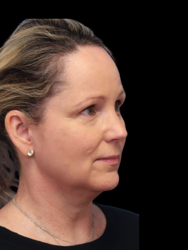 Blepharoplasty Before & After