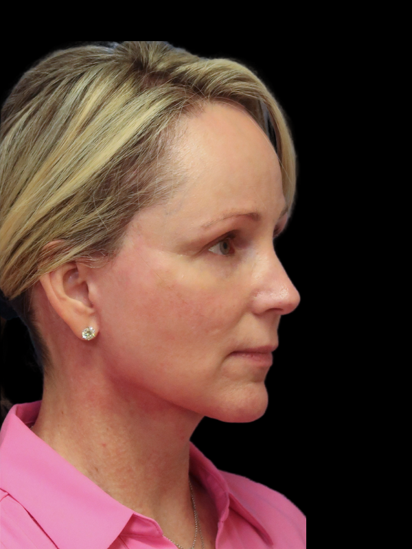 Blepharoplasty Before & After