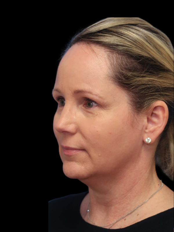 Blepharoplasty Before & After