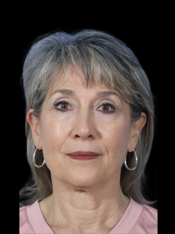 Blepharoplasty Before & After