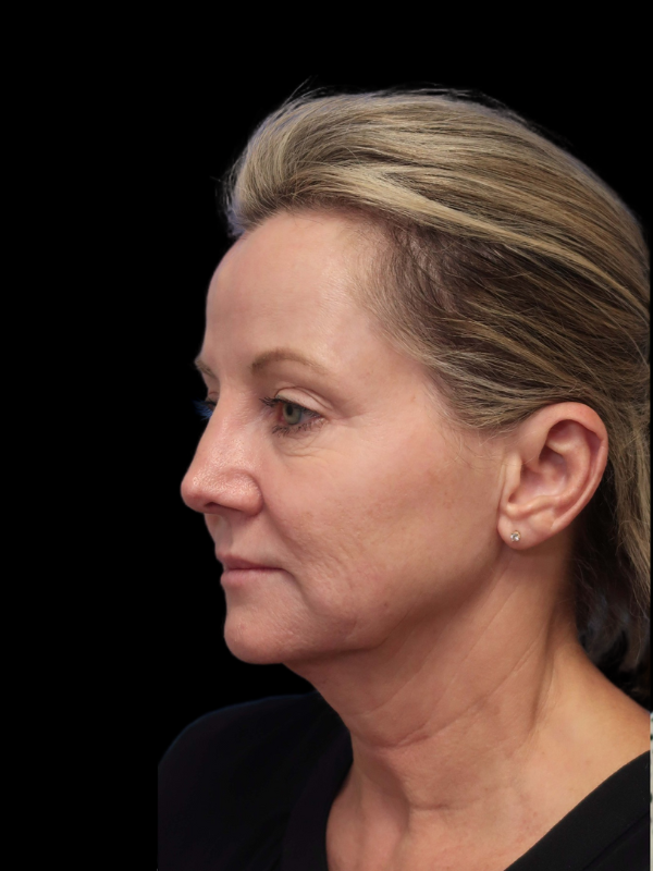 Blepharoplasty Before & After