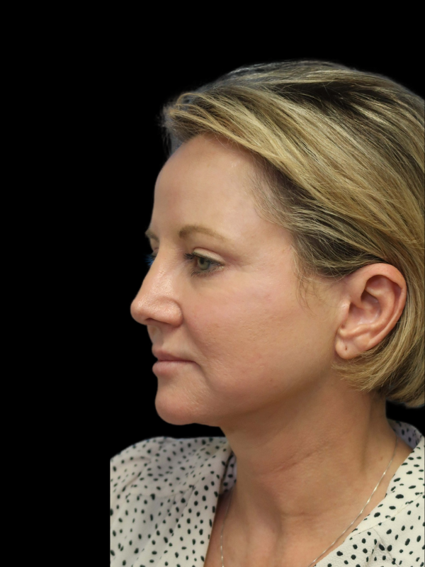 Blepharoplasty Before & After