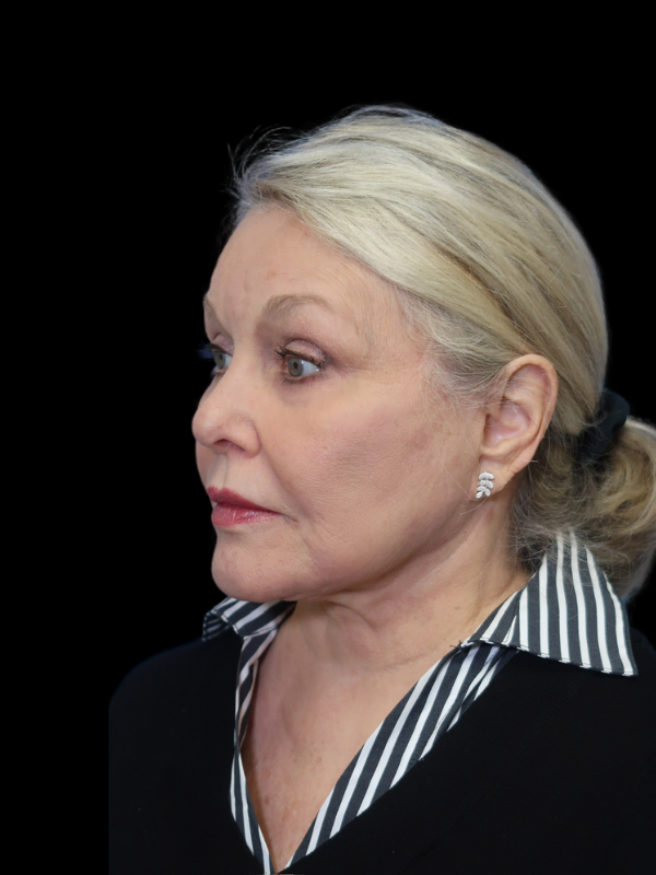 Blepharoplasty Before & After