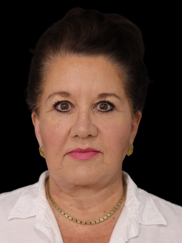 Blepharoplasty Before & After