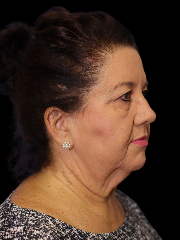 Blepharoplasty Before & After