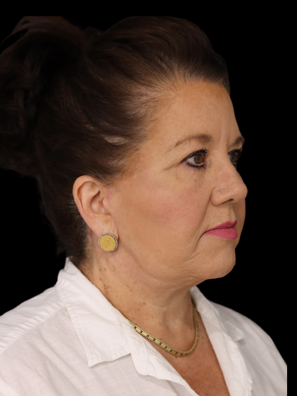 Blepharoplasty Before & After