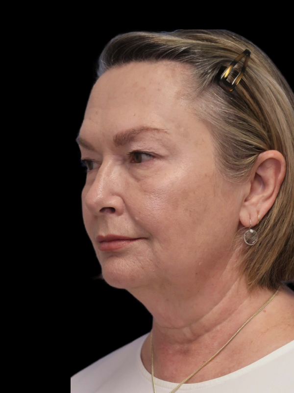 Blepharoplasty Before & After