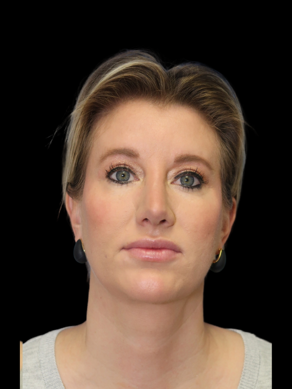 Blepharoplasty Before & After