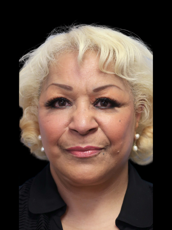 Blepharoplasty Before & After