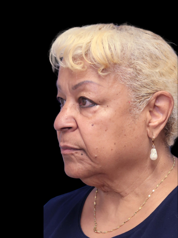 Blepharoplasty Before & After