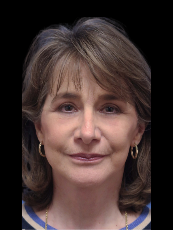 Blepharoplasty Before & After