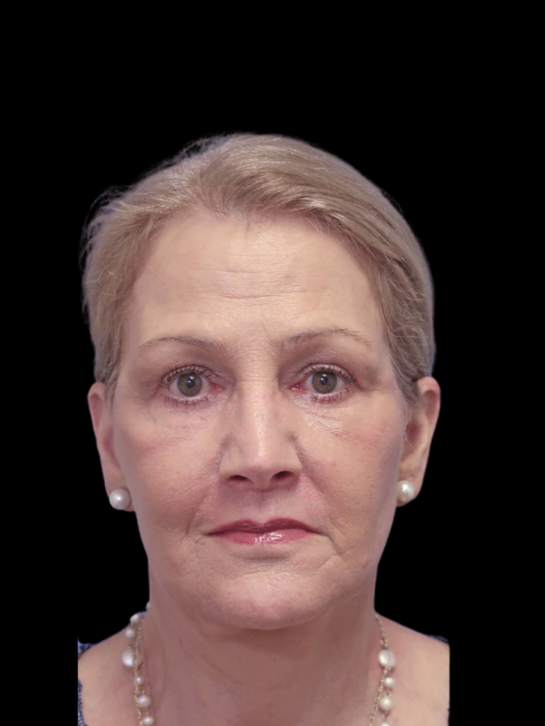 Blepharoplasty Before & After