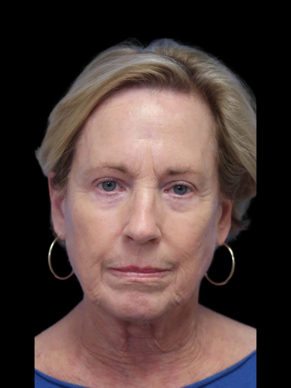 Blepharoplasty Before & After