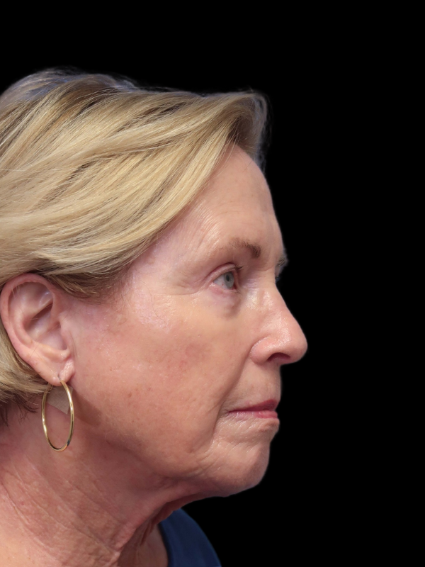 Blepharoplasty Before & After