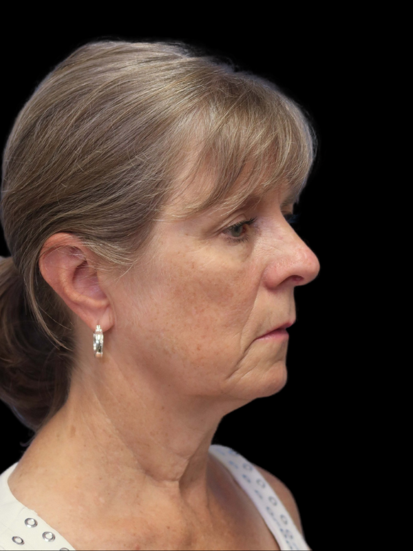 Blepharoplasty Before & After