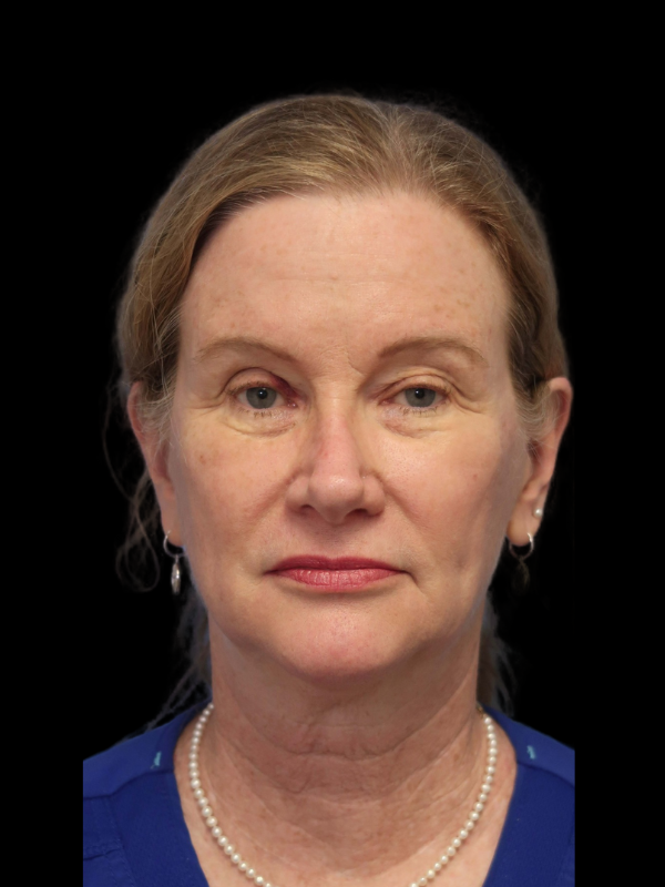 Blepharoplasty Before & After